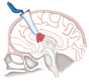 Brain minimal invasive technique