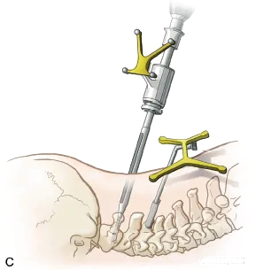 Navigation spine 3
